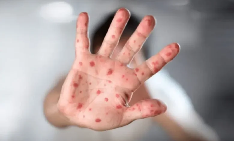 تسجيل أول حالة إصابة بجدري القردة بمدينة مراكش