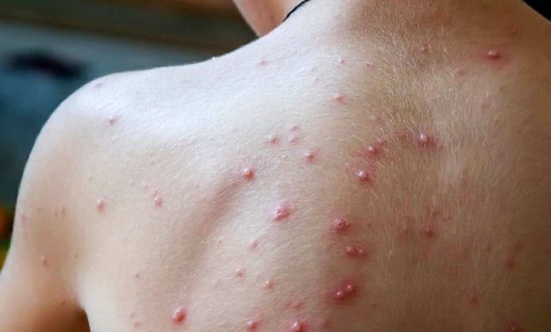 مؤسسة “MAScIR” تعلن عن تطوير إعتماد طقم جديد لتشخيص جدري القردة